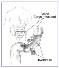 The colon (large intestine) and an enlargement of it showing diverticula