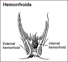 Hemorrhoids