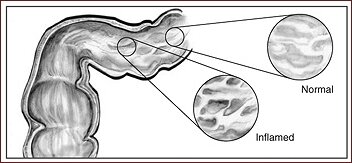 Normal - Inflamed