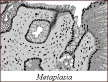 Metaplasia