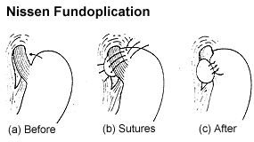 Nissen Fundoplication