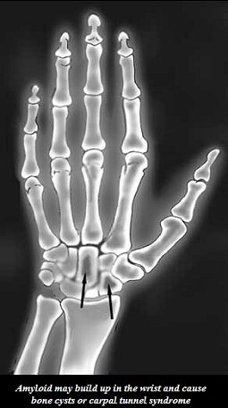  may build up in the wrist and cause bone cysts or carpal tunnel syndrome.